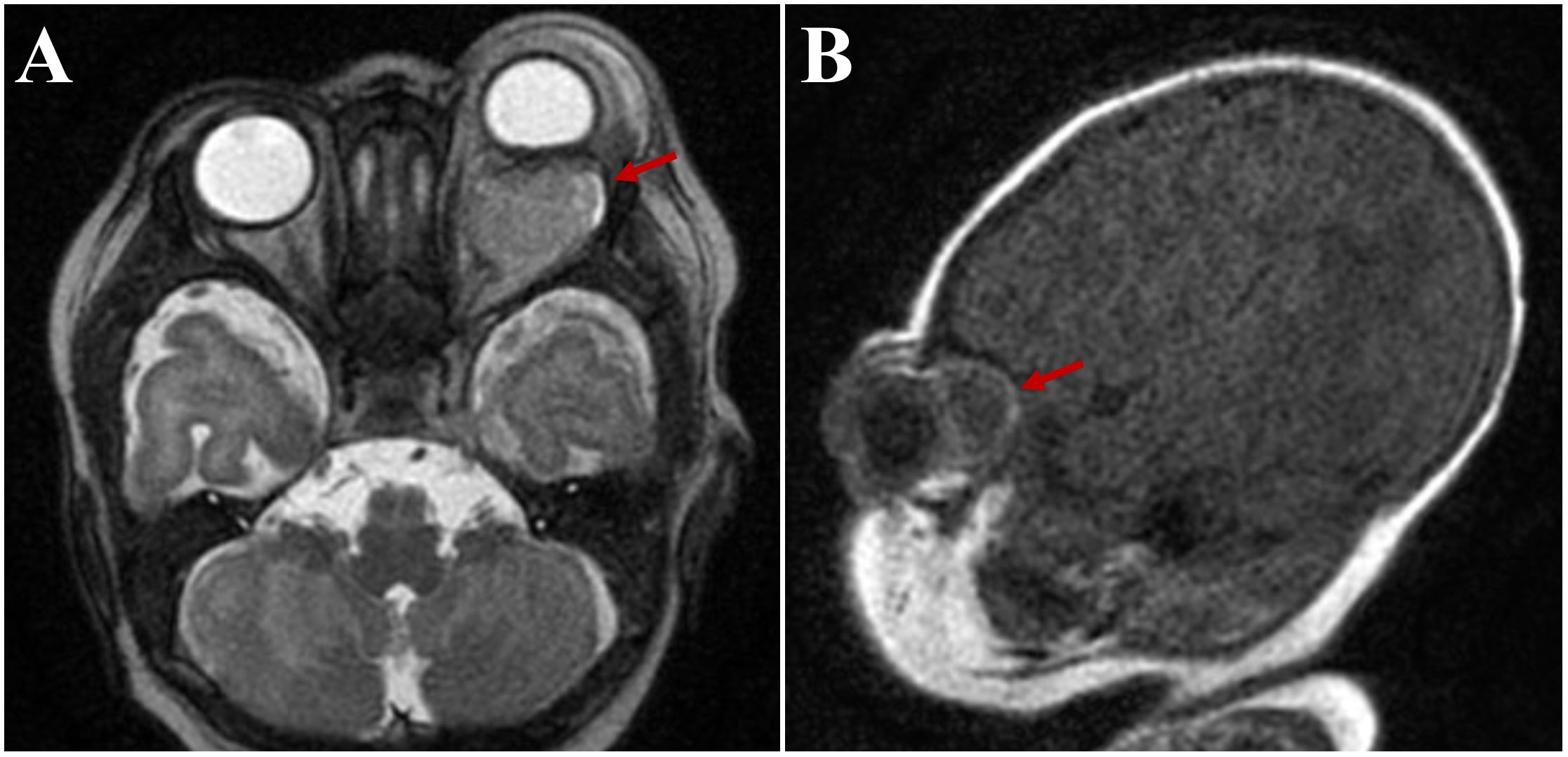 MRI images showing a brain scan. Panel A depicts an axial view with a highlighted mass near the left eye, indicated by a red arrow. Panel B displays a sagittal view highlighting a similar mass, also marked by a red arrow.