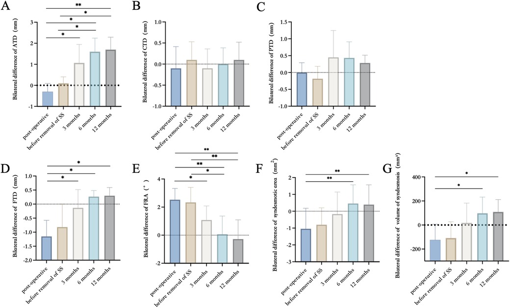 Seven bar graphs (A to G) showing bilateral differences over time post-operation. They compare changes in measurements such as ATD, CTD, and others across time points: post-operative, before removal of SS, 3 months, 6 months, and 12 months. Each graph shows significant differences marked with asterisks.