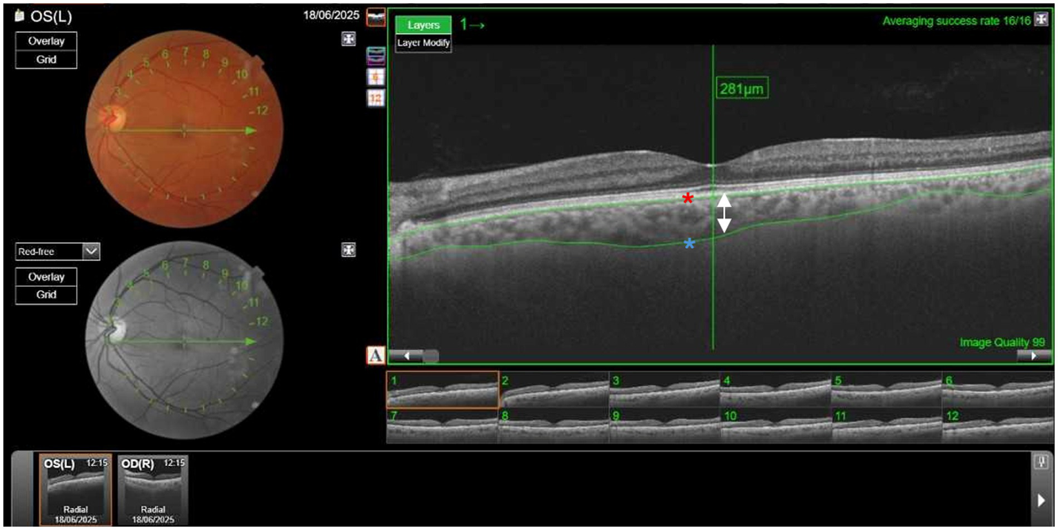 Retinal imaging display with color and red-free views of the left eye on the left, marked with grid overlays. On the right, an Optical Coherence Tomography (OCT) scan shows retinal layers with measurements labeled at 281 micrometers. The image quality is noted as 99.