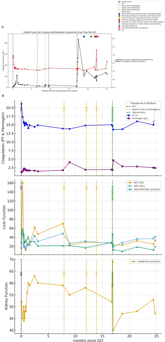Chart showing medical data over time post-organ liver transplant (OLT). Panel A plots platelet count and INR, marking surgical and medication interventions including splenic artery embolization. Panel B tracks coagulation (PT & fibrinogen), liver function (ALT, AST, total bilirubin), and kidney function (creatinine). Data is shown monthly, with key procedures and timelines indicated by vertical lines.