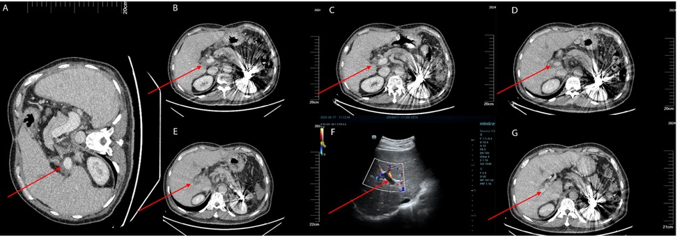 CT and ultrasound images show abdominal cross-sections. Red arrows point to specific areas, indicating points of interest likely related to a medical diagnosis. Images are labeled A to G.
