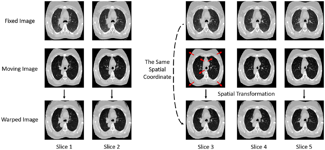 CT scan slices depicting image registration with fixed, moving, and warped images. Left panel shows two slices each for fixed, moving, and warped images. Right panel shows spatial transformation and alignment across five slices. Red arrows indicate a spatial transformation step.