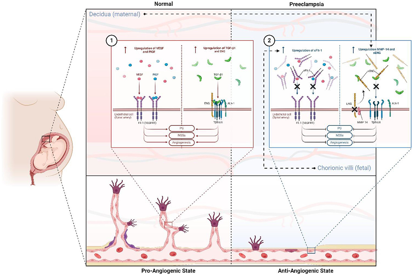 Diagram illustrating the differences in angiogenic states between normal pregnancy and preeclampsia. On the left, normal conditions show upregulation of VEGF and PlGF in decidual maternal tissue, leading to a pro-angiogenic state. On the right, preeclampsia conditions show upregulation of sFlt-1, TGF-β1, and ENG, causing an anti-angiogenic state. The bottom part visualizes the changes in chorionic villi structure, with more angiogenesis in the normal state and reduced angiogenesis in preeclampsia. A side view of a pregnant woman displays the location of these processes.