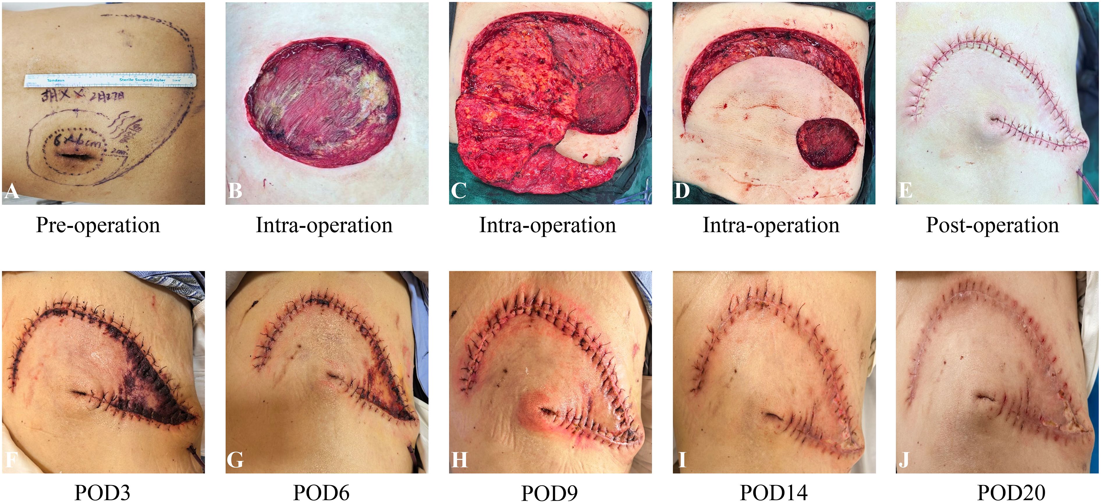 A series of images depict the stages of a surgical procedure and recovery on the skin. Image A shows pre-operation markings. Images B, C, and D display intra-operative views with exposed tissue. Image E shows immediate post-operative stitches. Images F to J illustrate the healing process on postoperative days three, six, nine, fourteen, and twenty, with progressive reduction in swelling and improved suture appearance.