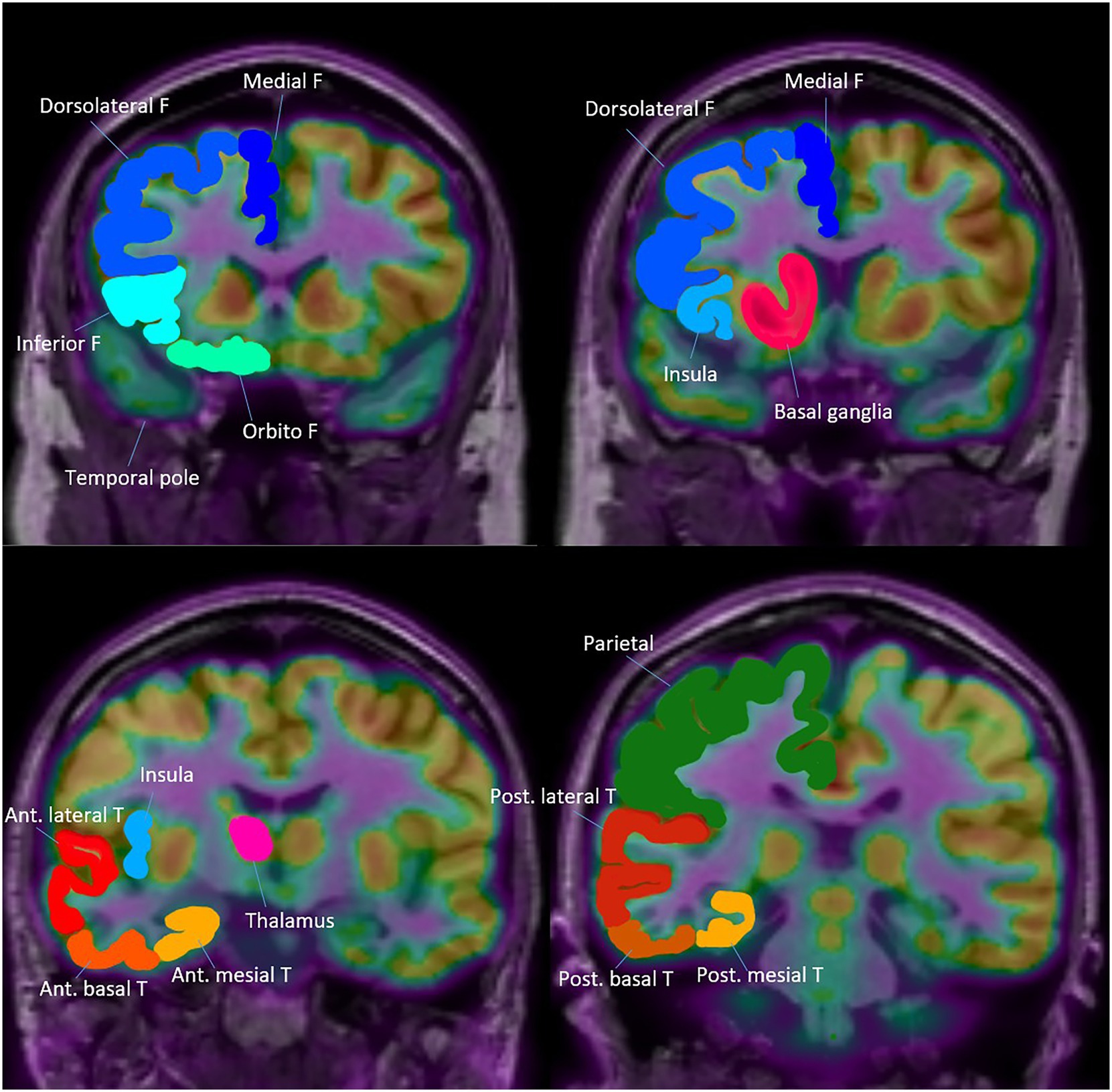 Topography of Anatomical areas assessed for regional hypometabolism on coronal FDG-PET images. This figure shows coronal schematic FDG-PET views outlining the anatomical areas evaluated for regional hypometabolism in the temporal lobe. It depicts anterior, posterior, mesial, lateral, and basal subregions that served as regions of interest in the analysis. The schematic provides spatial context for understanding how regional metabolism was assessed and compared across groups.
