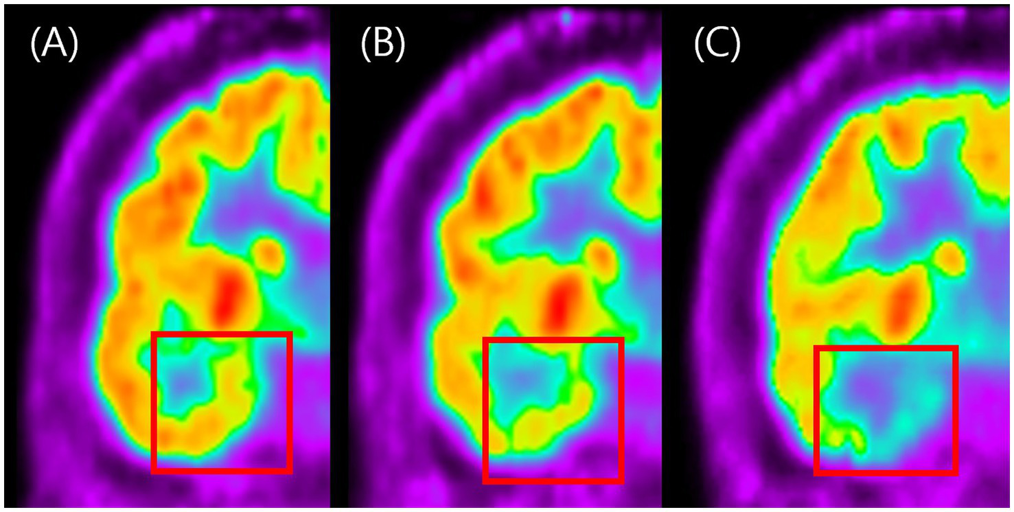 Visual grading examples of temporal hypometabolism on FDG-PET. This figure shows representative coronal FDG-PET images illustrating the three-grade visual scale used to classify the severity of temporal hypometabolism. Panel A represents normal symmetric metabolism with no reduction (Grade 0). Panel B shows mild localized reduction in metabolic activity (Grade 1), while panel C shows marked and extended reduction with clearly decreased FDG uptake (Grade 2). The figure demonstrates how visual grading was applied to categorize hypometabolism severity in this study.