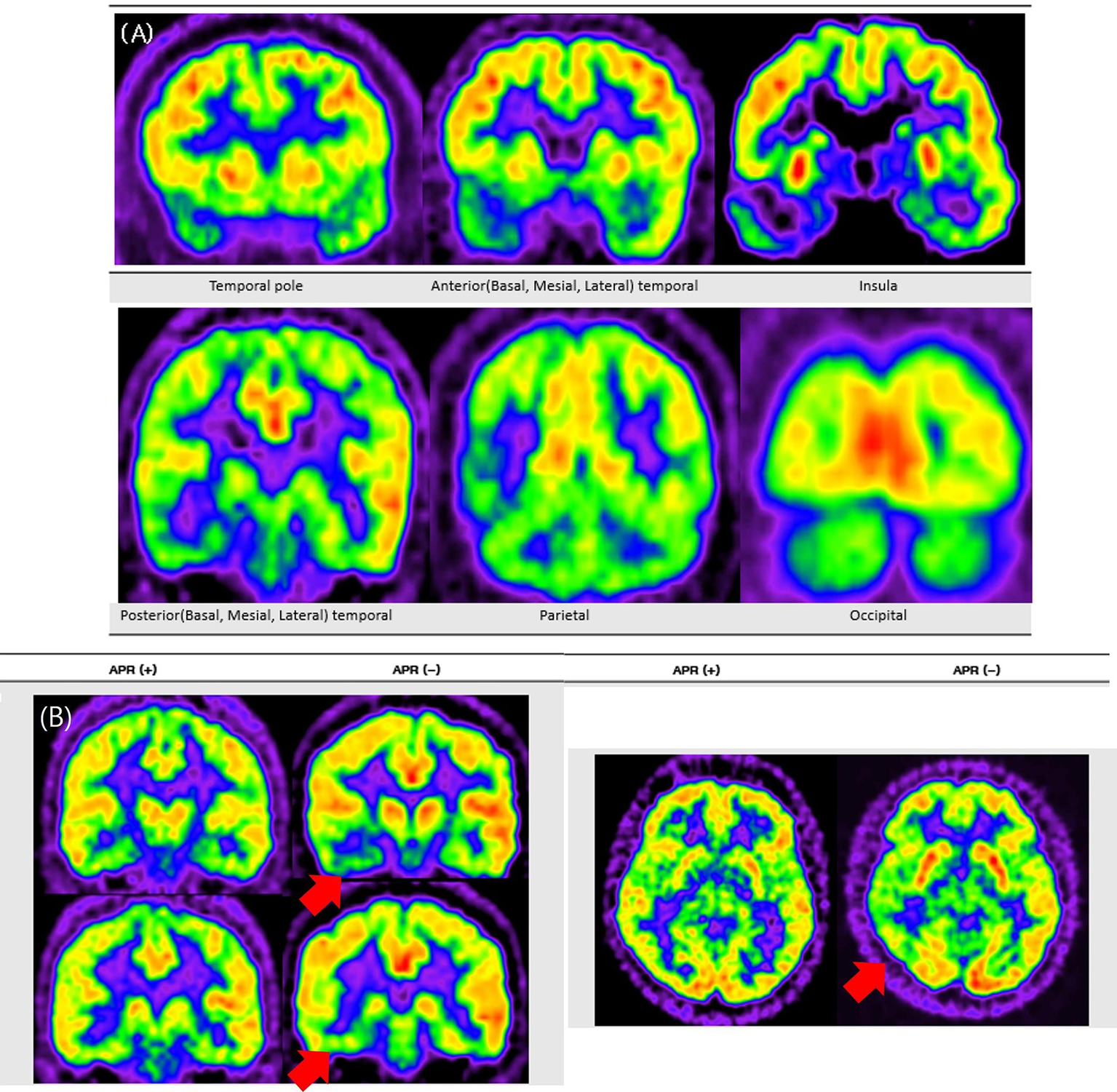 Representative FDG-PET images contrasting APR− and APR+ patients. This figure presents FDG-PET images comparing patients with and without preserved ictal responsiveness (APR+ and APR−). Panel A shows a typical pattern of extensive hypometabolism in a representative patient with right mesial temporal lobe epilepsy, involving the temporal pole and extending to temporal, parietal, insular, and occipital regions. Panel B shows two patient examples, where red arrows indicate more pronounced ipsilateral posterior temporal hypometabolism in the APR− patient compared to the APR+ patient.