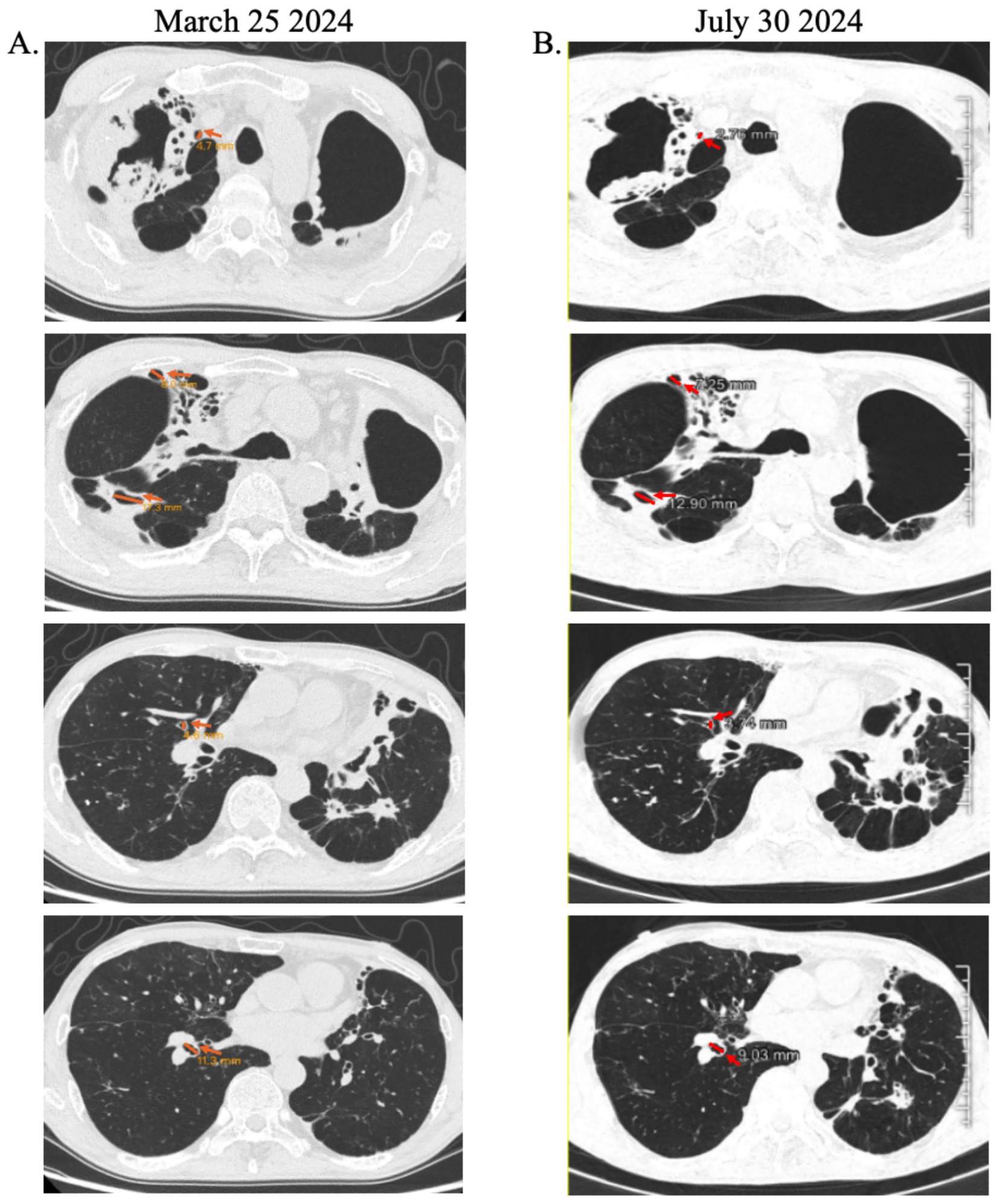 CT scans comparing lung images on March 25, 2024, and July 30, 2024. Panel A shows scans from March with measurements of lesions marked in orange. Panel B shows scans from July with updated measurements in red. Differences in lesion size and appearance are visible between the two dates.
