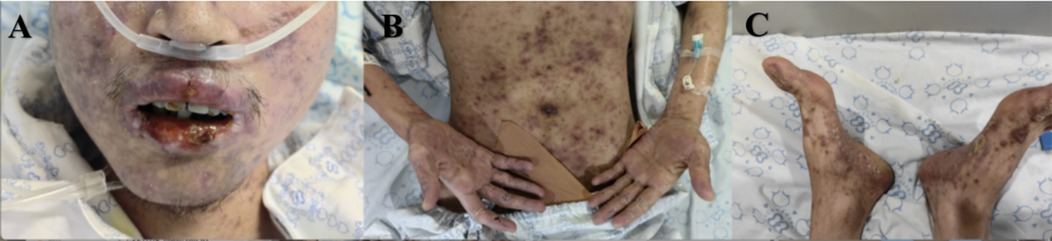 Medical images showing skin and facial lesions. Panel A: A person's face with pronounced lesions around the mouth. Panel B: Abdomen and hands displaying extensive purplish lesions on the skin. Panel C: Feet with similar lesions, including some crusting.