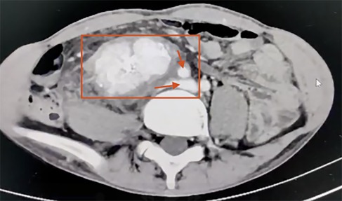 CT scan showing a cross-sectional view of the abdomen. An area within a red rectangle highlights a noticeable mass, with two arrows pointing toward specific portions within the mass.