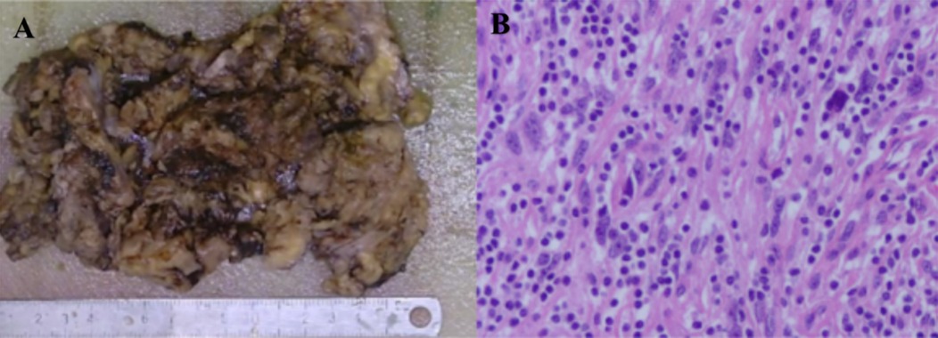 Panel A shows a large, irregularly shaped biopsy specimen with a textured surface. Panel B presents a microscopic view of tissue, highlighting densely packed cells with purple nuclei and pink cytoplasm, indicative of specific histological staining.