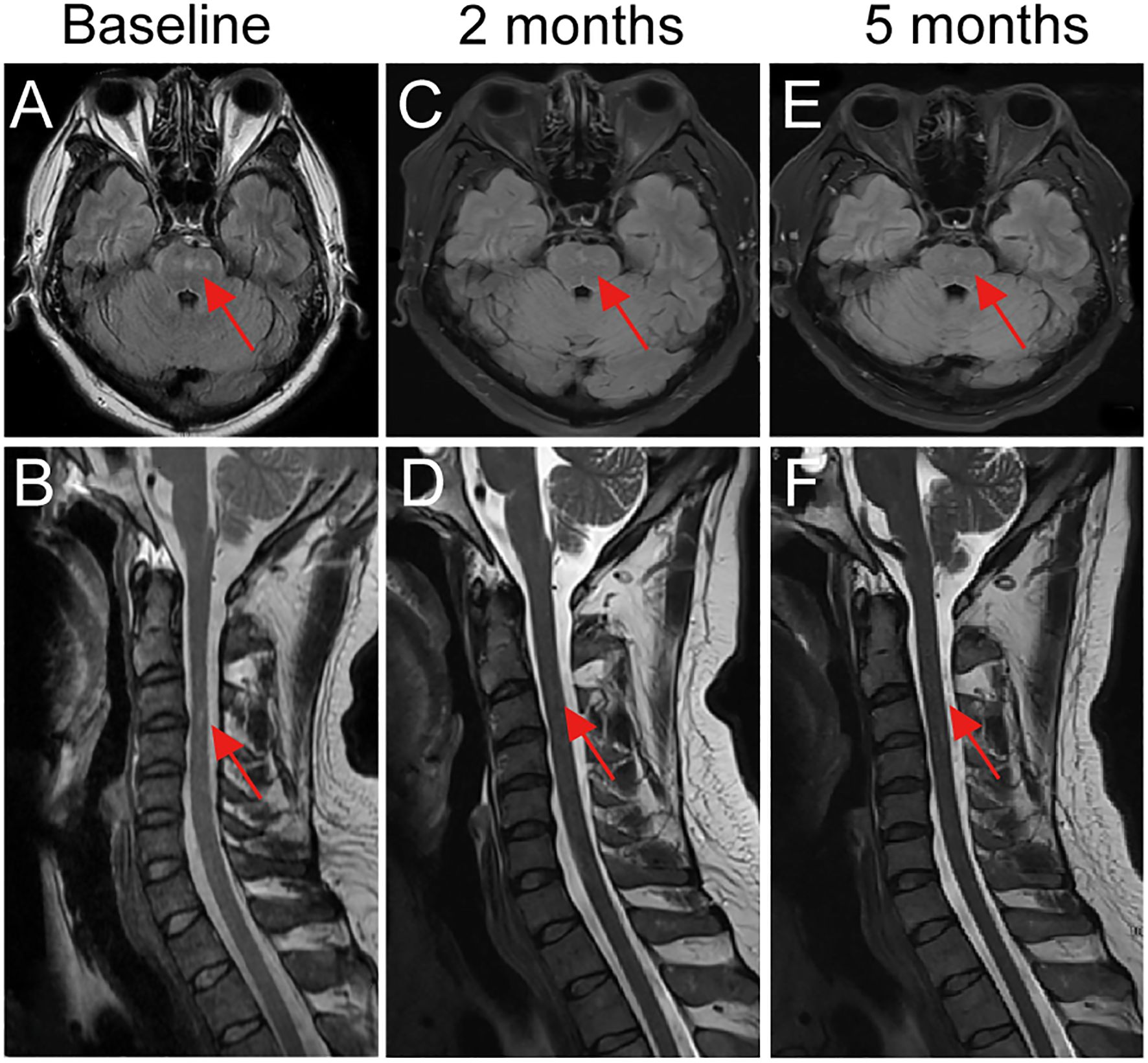 Three pairs of MRI scans show changes over time in a medical condition. The top row (A, C, E) presents axial brain images at baseline, two months, and five months, respectively, with red arrows indicating a consistent location in the brain. The bottom row (B, D, F) presents sagittal images of the spine at the same intervals, with red arrows highlighting changes in the spinal cord area. Each image suggests progression or change in the observed region over five months.