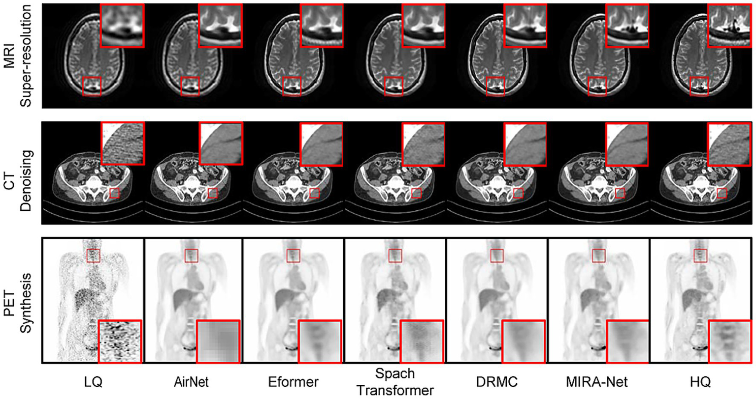 Medical image comparisons showing MRI super-resolution, CT denoising, and PET synthesis using various methods. Each row displays similar images with sections highlighted in red boxes, illustrating differences in image quality and detail across different approaches labeled as LQ, AirNet, Eformer, Spach Transformer, DRMC, MIRA-Net, and HQ.
