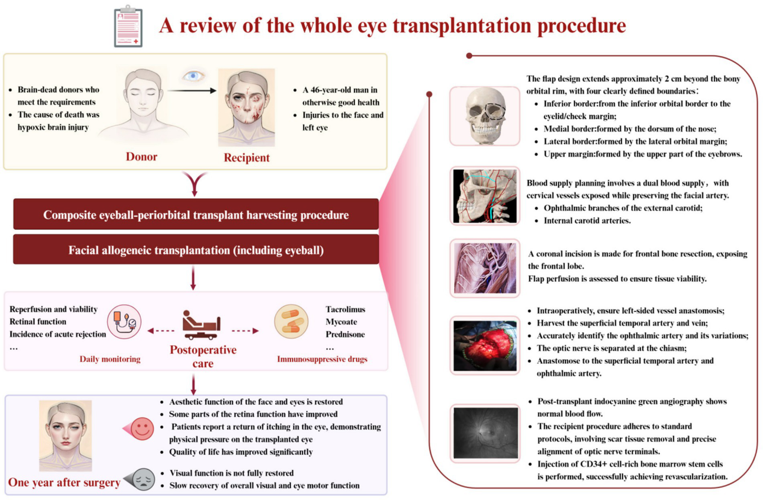 A comprehensive infographic detailing the whole eye transplantation procedure. It highlights the donor and recipient criteria, including brain-dead donors and a 46-year-old male recipient with facial injuries. The process involves composite transplant harvesting and facial allogeneic transplantation. Postoperative care includes daily monitoring and immunosuppressive drugs. After one year, aesthetic restoration is noted, though visual function remains incomplete. Illustrations show surgical steps like flap design, blood supply planning, and incision techniques for bone resection. Additional procedures ensure proper anastomosis and revascularization, supported by imagery of surgical actions and anatomical diagrams.