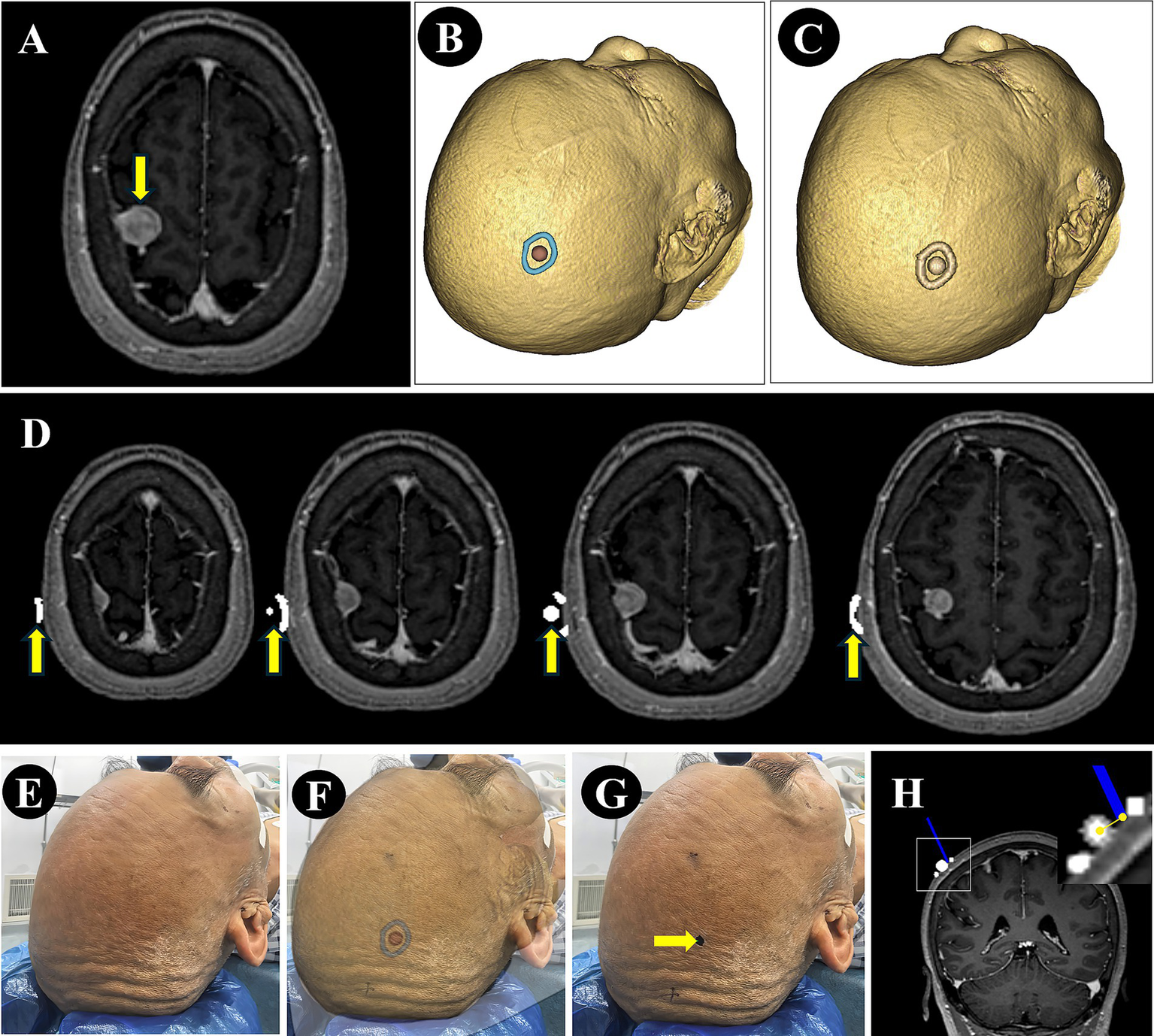 Medical imaging series showing a brain MRI (panels A and D) with highlighted lesions, and 3D head models (panels B and C) indicating marked areas. Panels E, F, and G display a person’s scalp with visible markings and an arrow pointing to specific areas. Panel H includes a detailed MRI view with blue arrows highlighting precise regions. This composite image illustrates a medical examination process focusing on cranial areas.