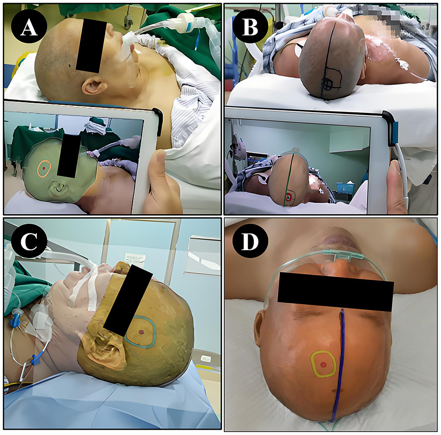 Four images labeled A to D depict a medical procedure involving a patient's head. A: A tablet shows augmented reality overlay on the patient's head. B: Side view with path marked. C: Closer side view with medical equipment attached. D: Top view highlighting specific area marked on the head. All patient faces are obscured for privacy.