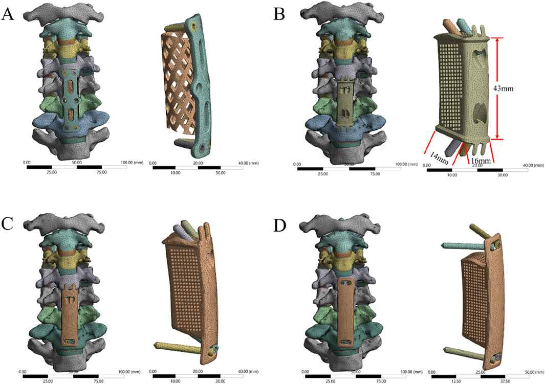 Four panels labeled A, B, C, and D show 3D models of cervical spine segments with different implant designs. Each panel features anterior and lateral views. Measurements are indicated in panel B, highlighting dimensions of the implant.