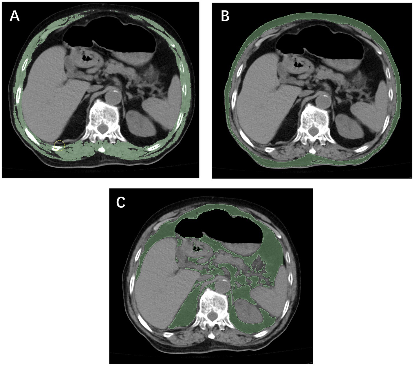 Three medical imaging scans labeled A, B, and C display cross-sectional views of the abdomen. Each scan highlights muscle and fat in green. Image A shows muscle volume highlighted at a specific point. Image B has a more uniform distribution. Image C depicts increased abdominal fat.