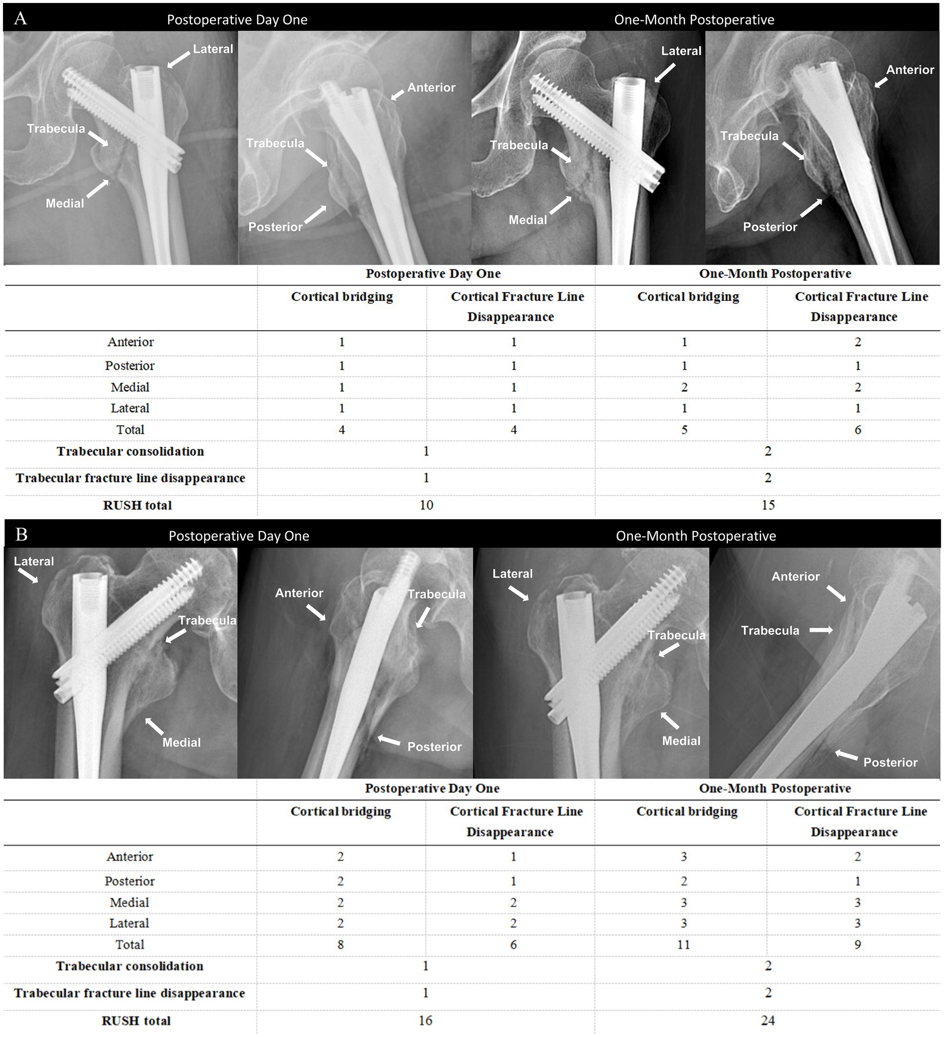 X-ray images and tables show postoperative evaluations of hip fractures at two time points: Day One and One-Month Postoperative. Labels indicate trabecular and cortical regions. Part A and B each have three X-rays showing different views with labeled directions such as lateral, anterior, posterior, and medial. Accompanying tables compare cortical bridging, fracture line disappearance, trabecular consolidation, and RUSH totals over time for each part. Part A shows RUSH totals of 10 and 15, whereas Part B shows 16 and 24 at Day One and One-Month respectively.
