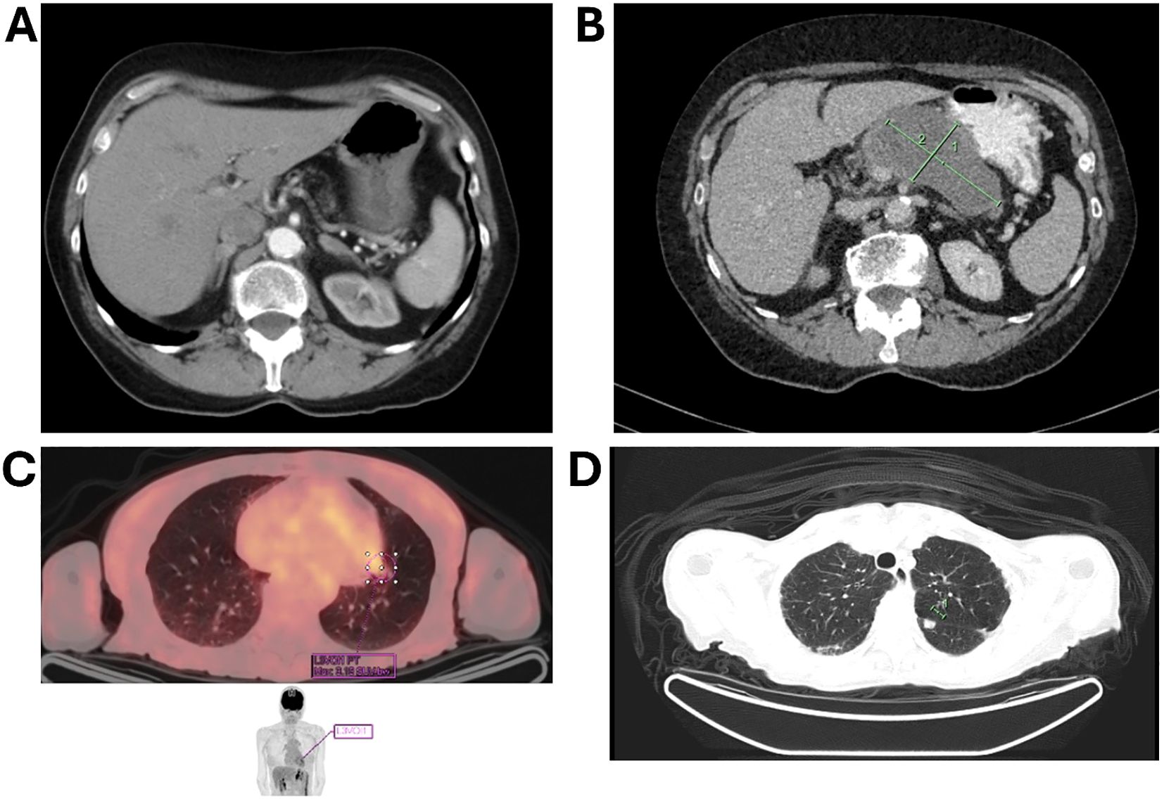 Four-panel medical imaging montage. Panel A: Abdominal CT scan showing various organs, including the liver and spleen. Panel B: Abdominal CT scan with dimensions marked on a mass. Panel C: PET scan of the chest highlighting high metabolic activity in a lung area. Panel D: Chest CT scan displaying lung structures with a highlighted region.