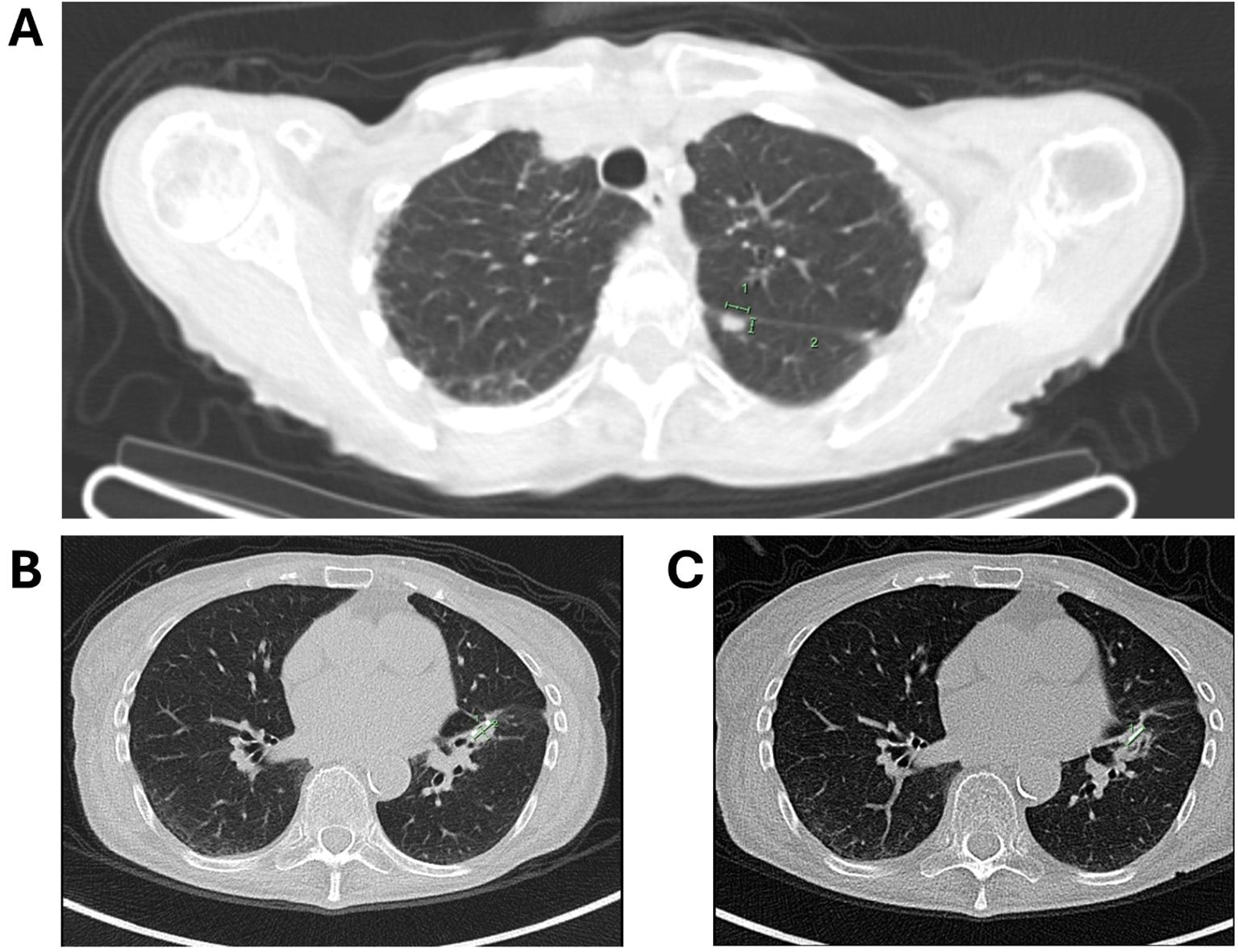 CT scan images in axial view showing three different sections of the lungs. Panel A shows an upper thoracic section with visible lung fields and spinal column. Panels B and C show sections of the lower thoracic area with lung parenchyma and central airways. Each image highlights specific areas in the lung tissue.
