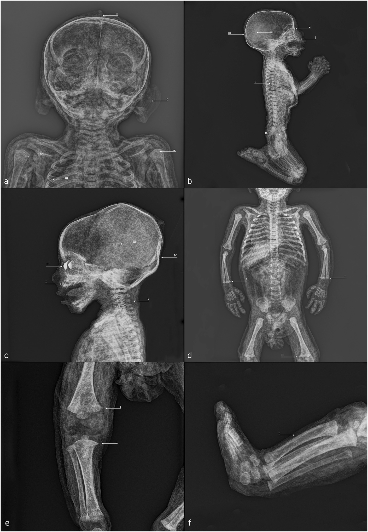 Six-panel image of a mummified child from the Capuchin Catacombs. Panel a shows a side profile of the child. Panel b focuses on the face with circles highlighting areas of interest, including the nose and a cheek. Panel c displays an arm and hand. Panel d zooms in on the chest area. Panel e shows the head from a side angle, highlighting an ear. Panel f captures the back with circles marking specific spots. The images emphasize the preserved state and detailed features of the mummified child.