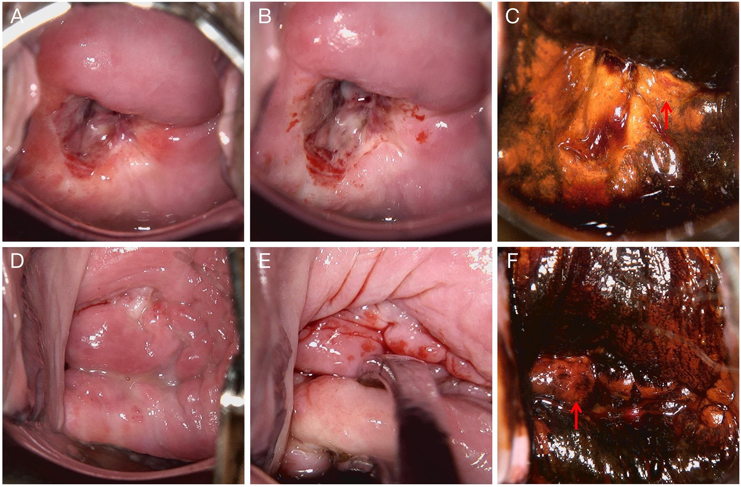 Endoscopic images of a medical procedure. (A) Top left: Native cervical appearance. (B)Top center: Acetowhite test showing dense acetowhite epithelium. (C) Top right: Lugol’s iodine staining demonstrating iodine-negative (unstained) areas suggestive of abnormal epithelium. (D) Bottom left: Native cervical appearance. (E) Bottom center: Acetowhite test showing faint acetowhite changes. (F) Bottom right: Lugol’s iodine staining demonstrating iodine-negative (unstained) areas suggestive of abnormal epithelium.