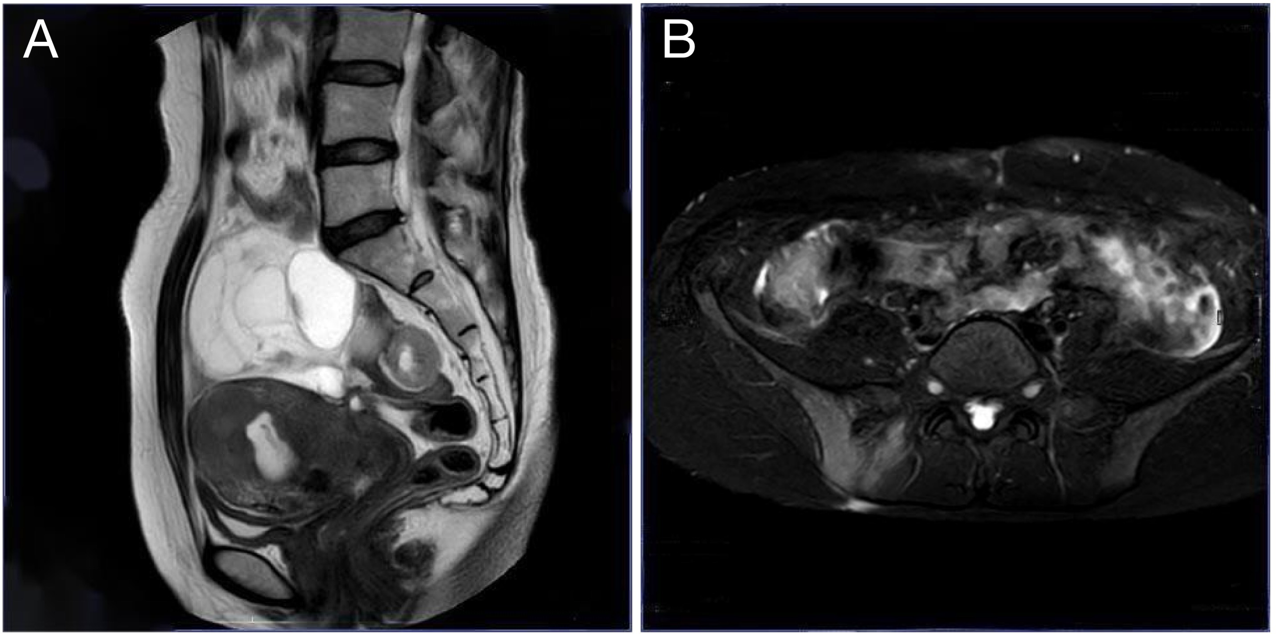 Two MRI images of the pelvic region are shown. The left image is a sagittal view, displaying a cystic pelvic mass compressing the uterus and rectum. The right image is an axial view, clearly showing a well-defined mass with involvement of the sacroiliac joints.
