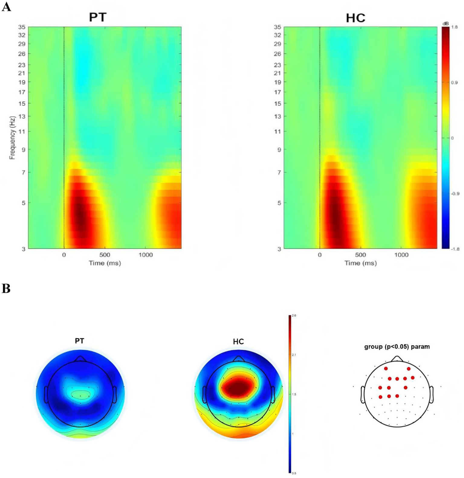 Panel A contains two time-frequency plots showing frequency (3 to 35 Hz) versus time (0 to 1000 ms) for PT and HC groups, with color indicating dB level changes. Panel B displays two topographical brain maps for PT and HC groups, with the color scale representing intensity. A third map highlights significant group differences with red dots.