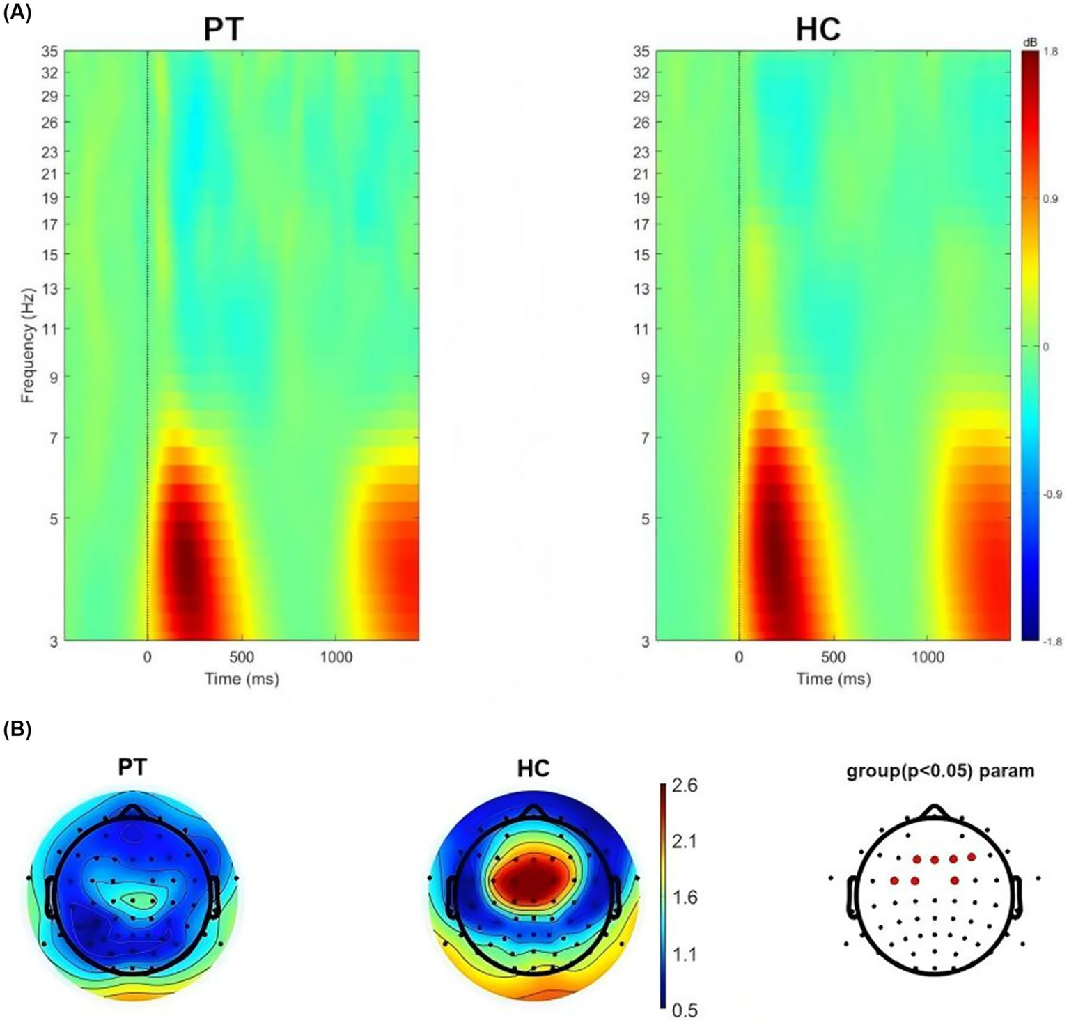 Panel A shows two time-frequency spectrograms, one labeled PT and the other HC. Both depict frequency in hertz over time in milliseconds, with colors ranging from blue to red, representing decibels. Panel B displays brain topographies for PT and HC, using a color scale from blue to red for power representation. The third diagram shows electrode significance with red dots indicating significance at specific locations.
