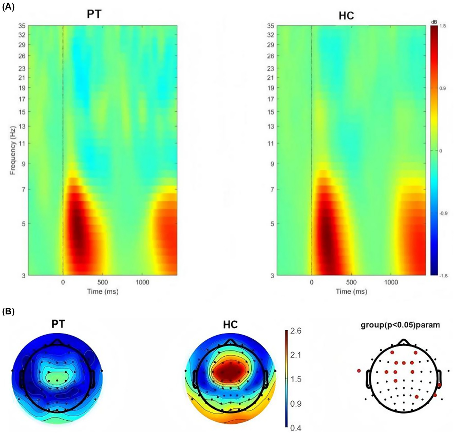 Two sets of brain activity visualizations. (A) Displays time-frequency plots comparing PT and HC groups. Both show changes in frequency (3-35 Hz) over time (0-1000 ms), with color gradients from red (higher) to blue (lower) in decibels. (B) Shows topographic head maps for PT and HC, with color indicating power levels. An additional diagram highlights significant differences (p<0.05) across groups, with red dots indicating relevant electrode sites.