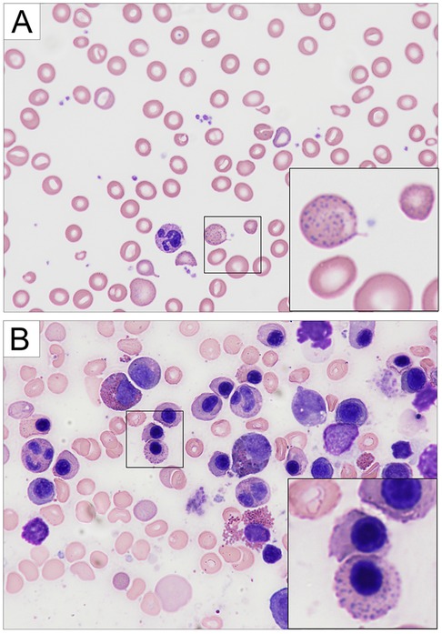 Microscopic images show two panels labeled A and B.Panel A depicts numerous red blood cells, focusing on a single erythrocyte that contains a distinct, purple-stained intracytoplasmic inclusion. Panel B shows erythroid precursor cells at various developmental stages, again highlighting one cell with a prominent, purple-stained inclusion. Both panels include zoomed-in insets providing detailed views of the inclusions.