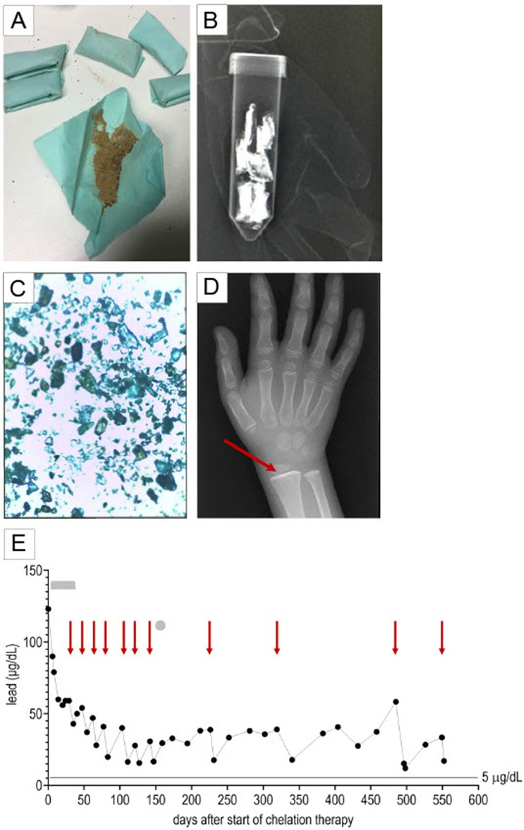 A composite figure consisting of five panels labeled A–E. A) Several small packets containing brown powder are displayed on blue paper. B) X-ray image of a vial filled with multiple small packets showing hyperdense contents. C) Microscopic view revealing crystalline structures. D) X-ray of a hand with a red arrow indicating a hyperdense line along the wrist. E) Graph illustrating blood lead levels (µg/dL) over time, with red arrows marking intervention points.
