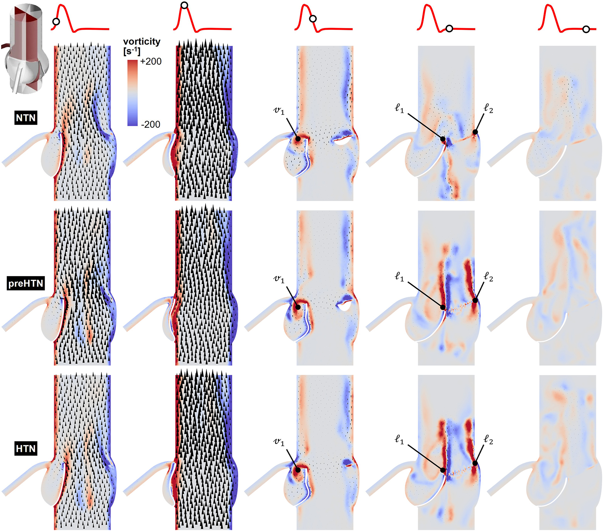 Comparison of blood flow dynamics in three conditions: NTN, preHTN, and HTN. Each column represents flow analysis with vorticity represented by colors from red (+200 s-1) to blue (-200 s-1). Arrows and labels indicate specific regions of flow difference. Diagrams show varied flow patterns across conditions.