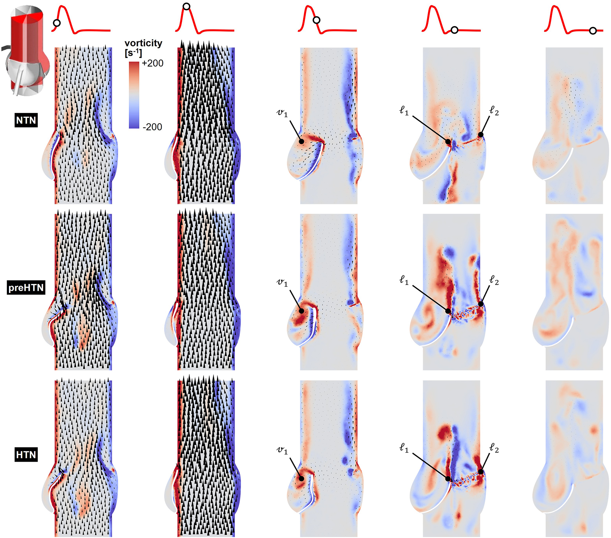 Comparative vorticity analysis visualization shows three vertical sections labeled NTN, preHTN, and HTN. Each section consists of multiple sub-sections with red and blue gradient mappings indicating vorticity levels. Vector arrows are used to depict flow direction. Specific points are marked with \\( \\nu_1 \\), \\( \\ell_1 \\), and \\( \\ell_2 \\) on the middle and right sub-sections. A color scale beside the first column ranges from +200 to -200 s\\(^-1\\). The diagram includes abstract red line drawings at the top indicating flow paths.
