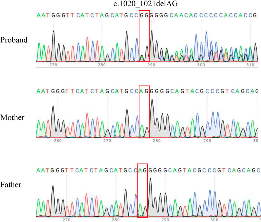 DNA sequencing chromatograms for the proband, mother, and father are shown in three rows. Each chromatogram displays peaks representing nucleotide bases (A, T, C, G). A red box highlights the c.1020_1021delAG deletion in the proband, indicating missing bases, while the parents