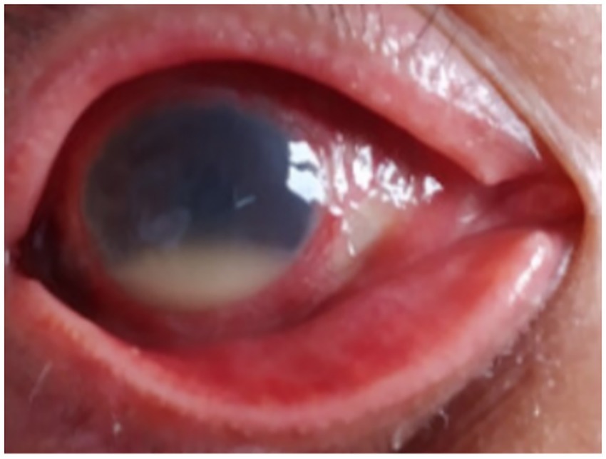 Close-up image of an inflamed, red lower eyelid and surrounding area, indicating irritation or infection. The eye is open, showing the sclera, pupil, and the iris.