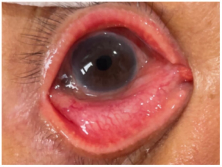 A close-up image of an eye showing signs of severe cataract. The cornea is cloudy, and the surrounding tissue appears swollen and red, indicating possible inflammation.