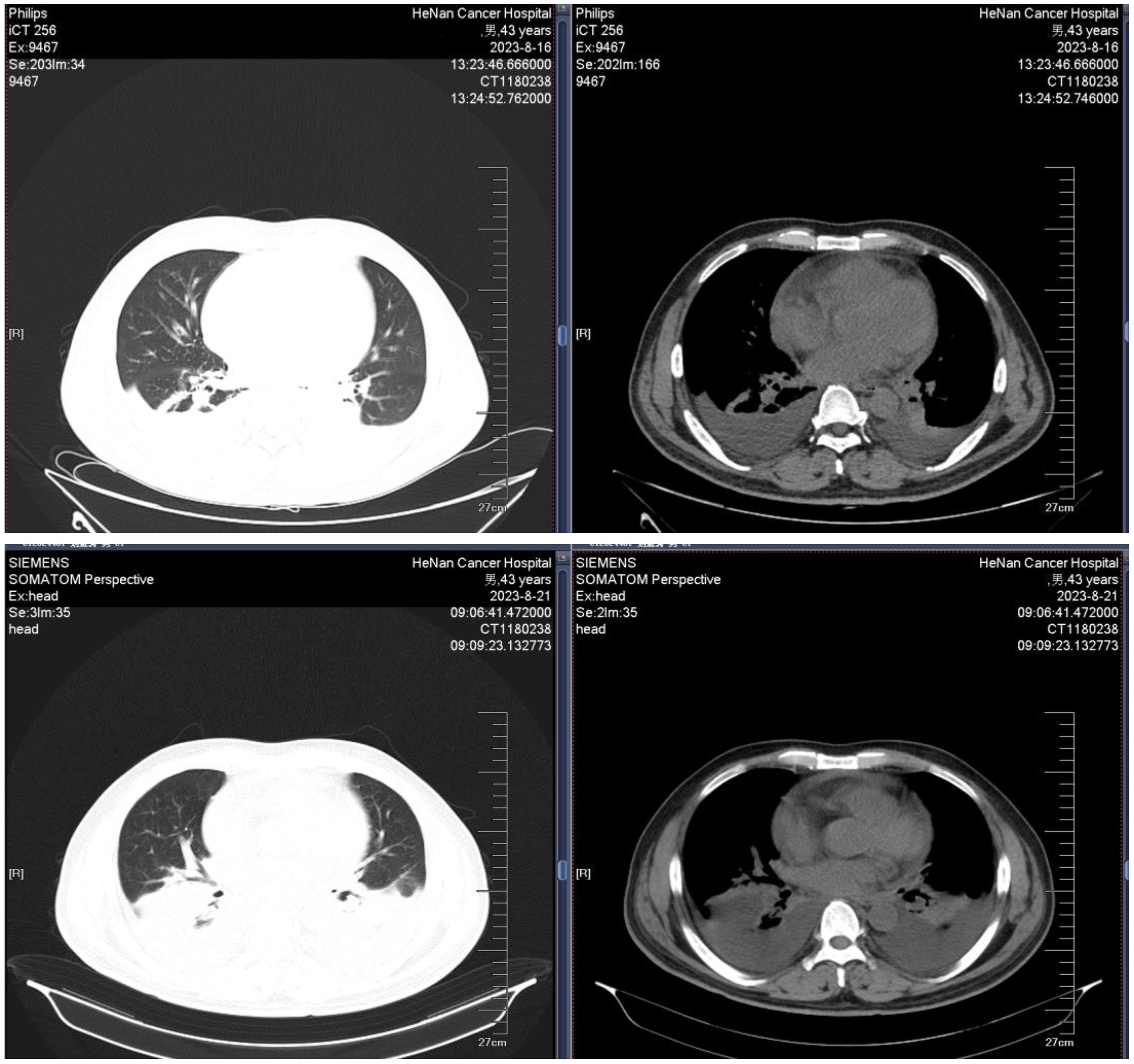 CT scan images showing cross-sectional views of the thorax. The top left and bottom left images highlight lung structures, while the top right and bottom right images focus on the heart and surrounding tissues. Dates and technical details are visible on the scans.