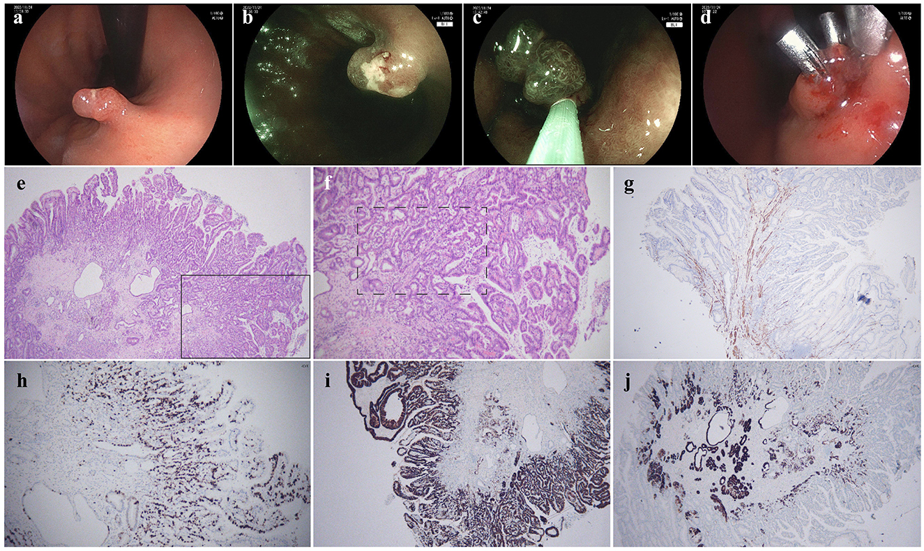 Panels a to d show endoscopic images of a polyp being inspected and removed. Panels e to j display histological slides. Panel e and f show tissue with epithelial characteristics. Panel g appears to show immunohistochemical staining. Panels h to j also show sections with possible staining variations, indicative of tissue analysis.