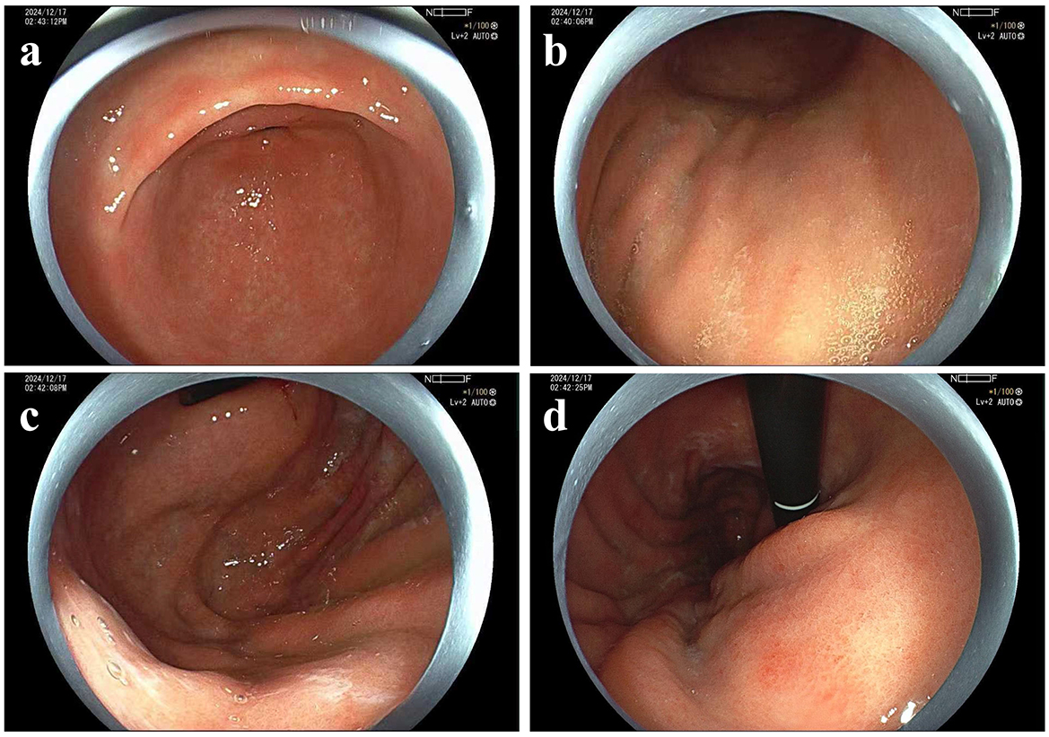 Four-panel endoscopic image showing the interior of the digestive tract. Panels (a) and (b) display smooth, reddish inner walls with visible texture. Panel (c) reveals slightly more undulating surfaces. Panel (d) shows an instrument inserted, surrounded by the soft tissue lining.