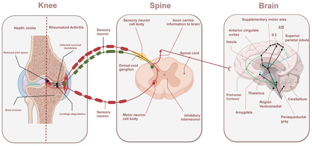 Diagram illustrating the pathway of rheumatoid arthritis pain from the knee to the brain. The knee section shows joint inflammation and cartilage degradation. Arrows depict sensory neurons transmitting signals via the dorsal-root ganglion to the spine and up the spinal cord. The brain section highlights areas involved in processing these signals, including the thalamus, cerebellum, and prefrontal cortex.