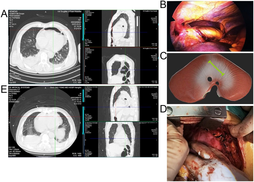 CT scan images in panels A and E display cross-sectional views of the chest area. Panel B shows an intraoperative image with notable coloration and structures. Panel C depicts a detailed illustration of a muscle or tissue with a green measurement line. Panel D features a surgical scene with hands in gloves handling tissue, indicating an ongoing procedure.