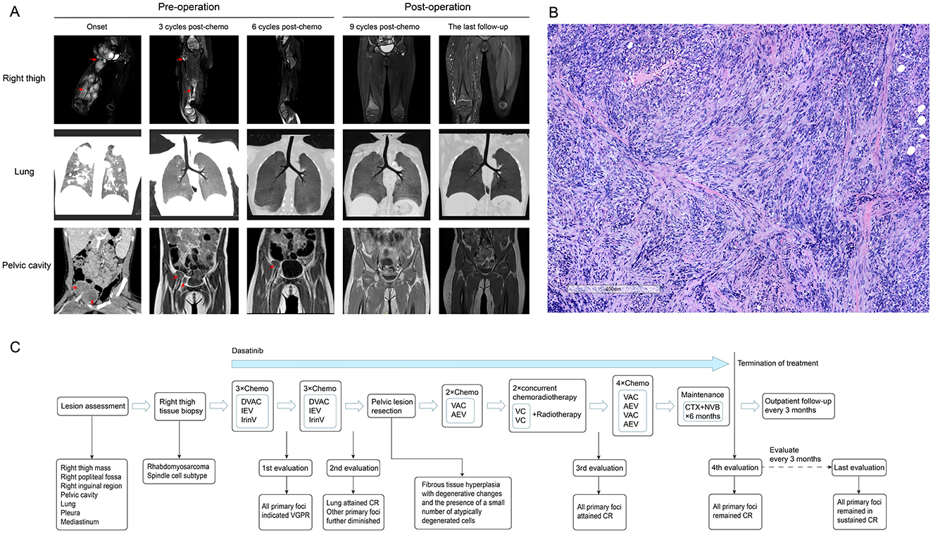 Panel A shows a series of MRI scans tracking the progression of lesions in the right thigh, lung, and pelvic cavity from onset through post-operation. Panel B displays a histological image of tissue, highlighting cell structure. Panel C presents a flowchart of the treatment plan and evaluations, featuring chemotherapy and radiotherapy regimens for rhabdomyosarcoma, leading from lesion assessment to treatment termination.