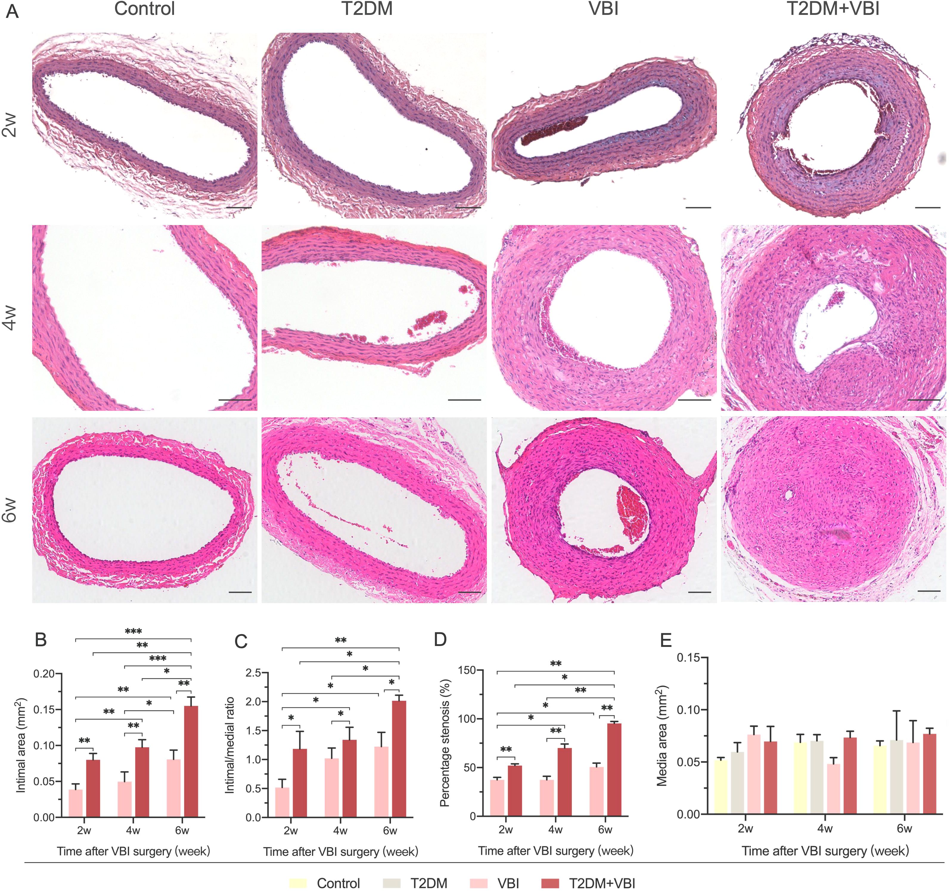 Histological images and bar graphs analyze the impact of diabetes (T2DM), vascular balloon injury (VBI), and their combination on vessels over time (2w, 4w, 6w). Panel A shows cross-sections of vessels. Panel B displays intimal area changes, Panel C shows intima/media ratios, Panel D presents percentage stenosis, and Panel E illustrates medial area changes. Different groups including control, T2DM, VBI, and T2DM+VBI are compared over weeks. Statistical significance is marked by asterisks.