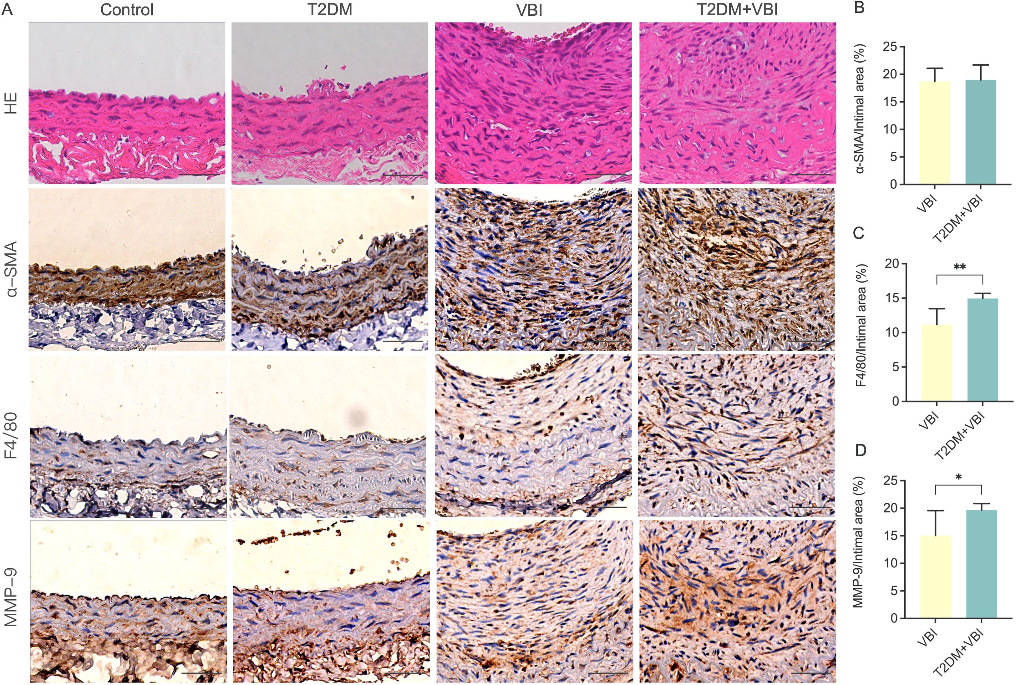 Histological analysis of vascular tissues from control, T2DM, VBI, and T2DM+VBI groups using HE, α-SMA, F4/80, and MMP-9 staining. Graphs (B, C, D) show quantification of α-SMA, F4/80, and MMP-9 positive areas. VBI and T2DM+VBI are compared, highlighting significant differences in F4/80 and MMP-9 with statistical annotations.