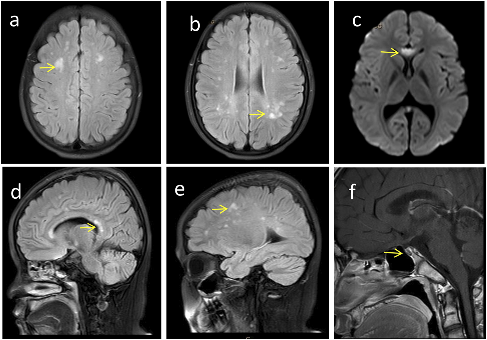 MRI scans of the brain showing various sections labeled a to f. Each image highlights specific areas with yellow arrows, indicating points of interest or abnormalities in the brain tissue. The scans are in axial and sagittal views, displaying different brain regions for detailed examination.
