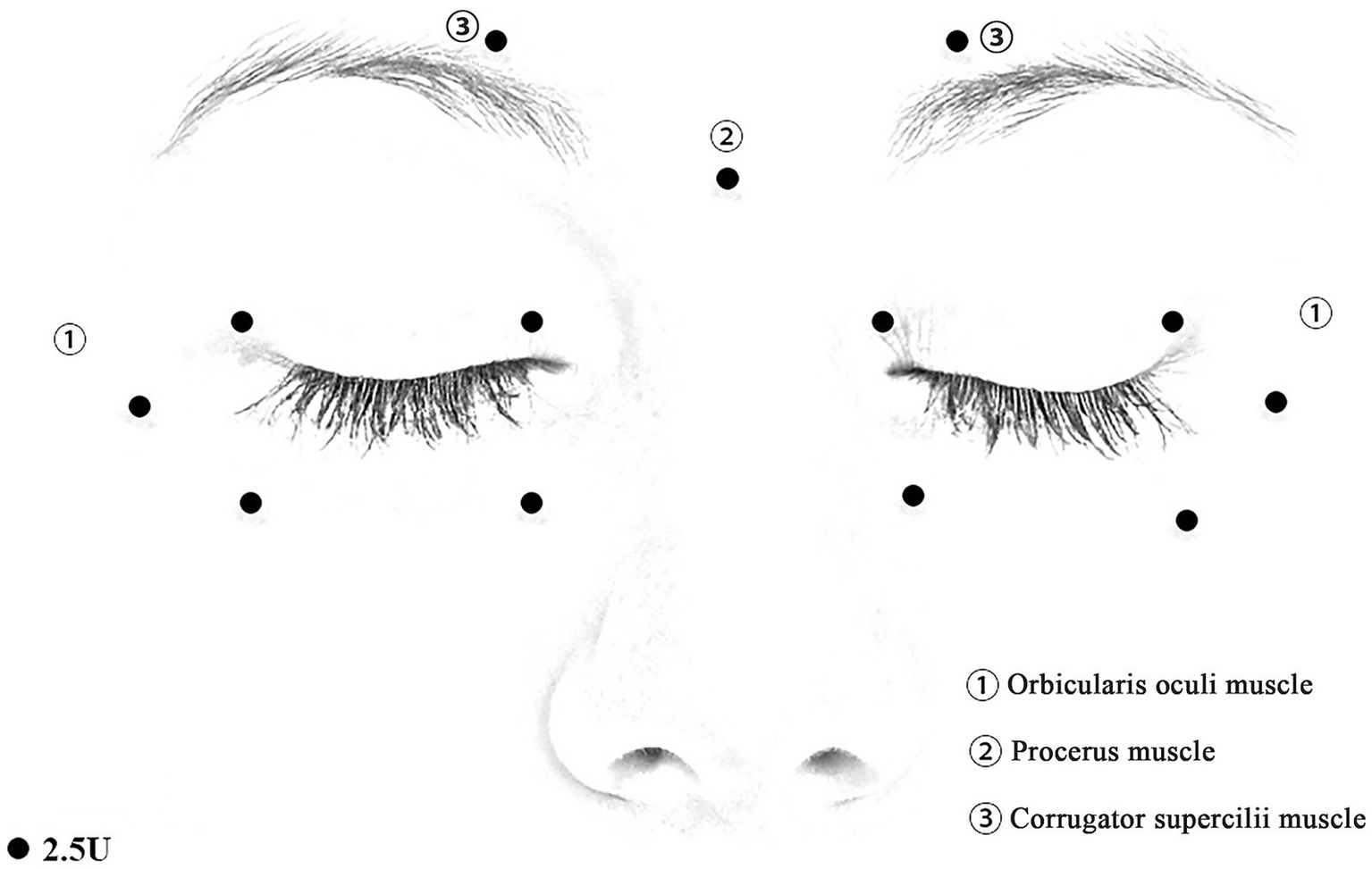 Diagram of a face showing closed eyes with injection points marked by black dots. Labeled areas indicate muscles: 1. Orbicularis oculi muscle, 2. Procerus muscle, 3. Corrugator supercilii muscle. Dosage noted as 2.5U.