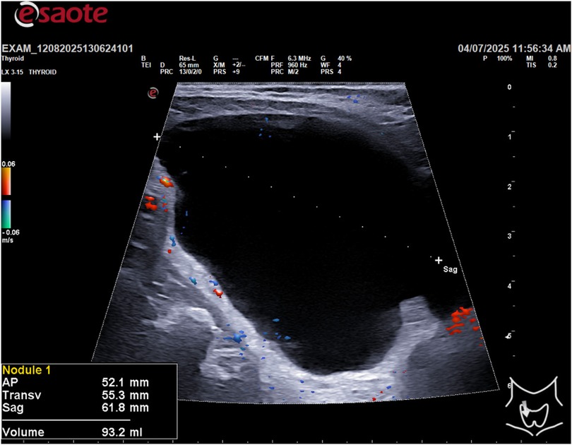 Ultrasound image with color Doppler of a thyroid nodule. Measurements show dimensions: anterior-posterior 52.1 mm, transverse 55.3 mm, sagittal 61.8 mm. Nodule volume is 93.2 ml. Color indicators suggest blood flow.