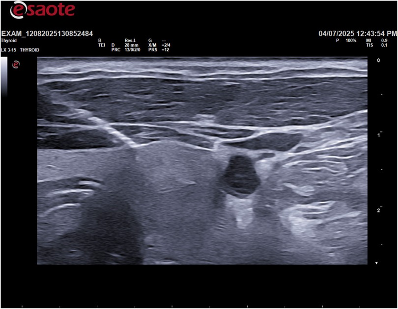 Ultrasound scan of a thyroid gland showing a dark region on the right, indicating potential abnormalities. The image includes indicators and measurements in the margins, typical of medical imaging.